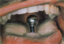 Piercingschäden 1.JPG (34111 Byte)