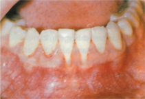 Piercingschäden 10.JPG (36551 Byte)