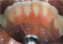 Piercingschäden 3.JPG (32509 Byte)