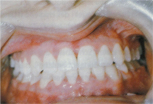 Piercingschäden 5.JPG (34369 Byte)
