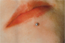 Piercingschäden 6.JPG (32226 Byte)