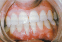 Piercingschäden 7.JPG (36016 Byte)