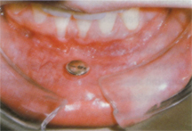 Piercingschäden 8.JPG (36277 Byte)
